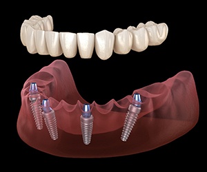 A 3D illustration of all-on-4 implants