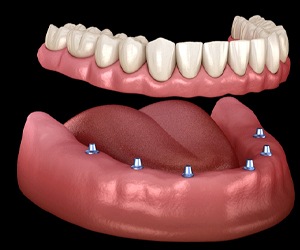 six dental implants in Plano, TX supporting an implant denture