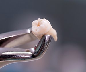 Metal clasps with extracted tooth