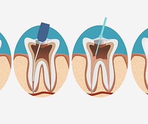 illustration for root canal therapy in Plano
