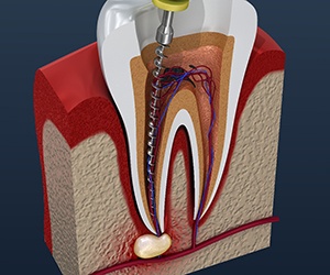 Illustration of root canal therapy in Plano, TX
