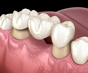 a dental bridge replacing a single missing tooth 