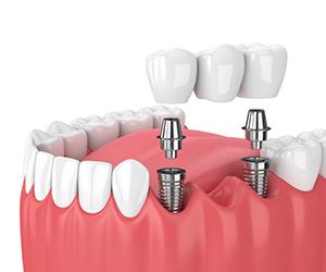 dental bridge being placed over two dental implant posts 