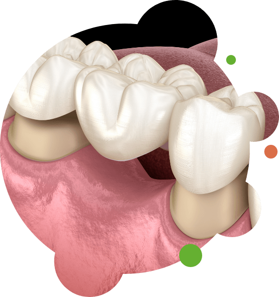 Illustration of dental bridge being attached to teeth