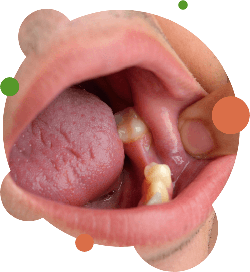 Pulling back lip to show missing teeth