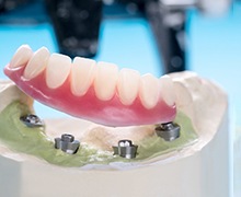 an example of an implant denture in Plano