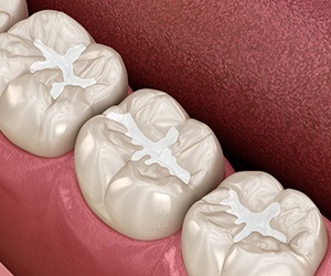 A 3D illustration of tooth-colored fillings
