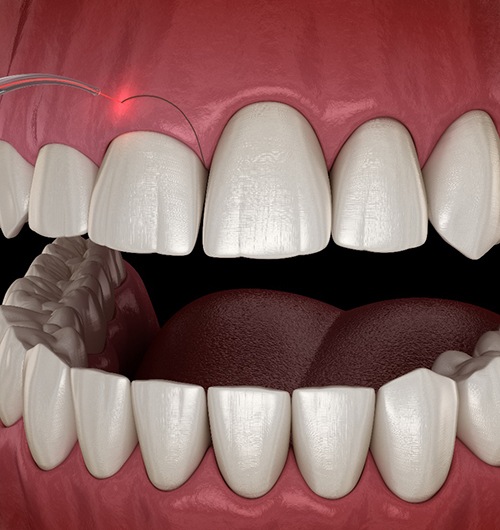 Digital image of gum recontouring