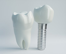 dental implant with crown next to an actual tooth