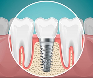 dental implant post and crown in the jawbone