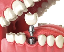 dental implant post, abutment, and crown being placed