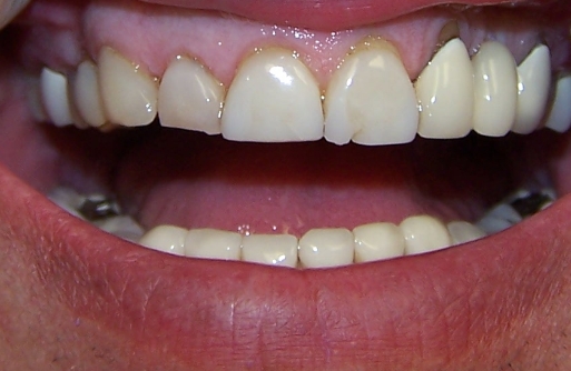 Close-up of chipped, worn down teeth