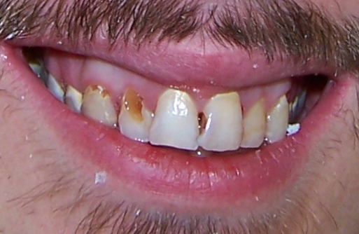 Close-up of teeth with discolored spots