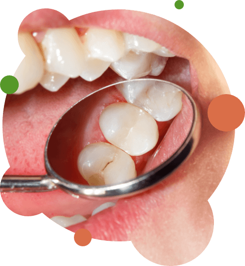 Dental mirror showing tooth with cavity