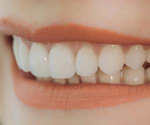 Closeup of woman smiling with veneers in Plano