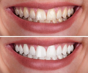before and after teeth whitening 