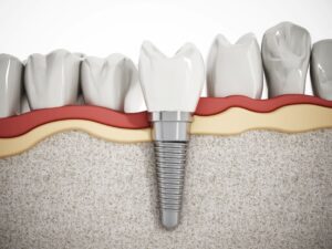 3D illustration of a dental implant imbedded in jawbone