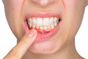 woman pointing to inflamed gums