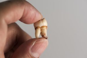 left hand holding extracted tooth