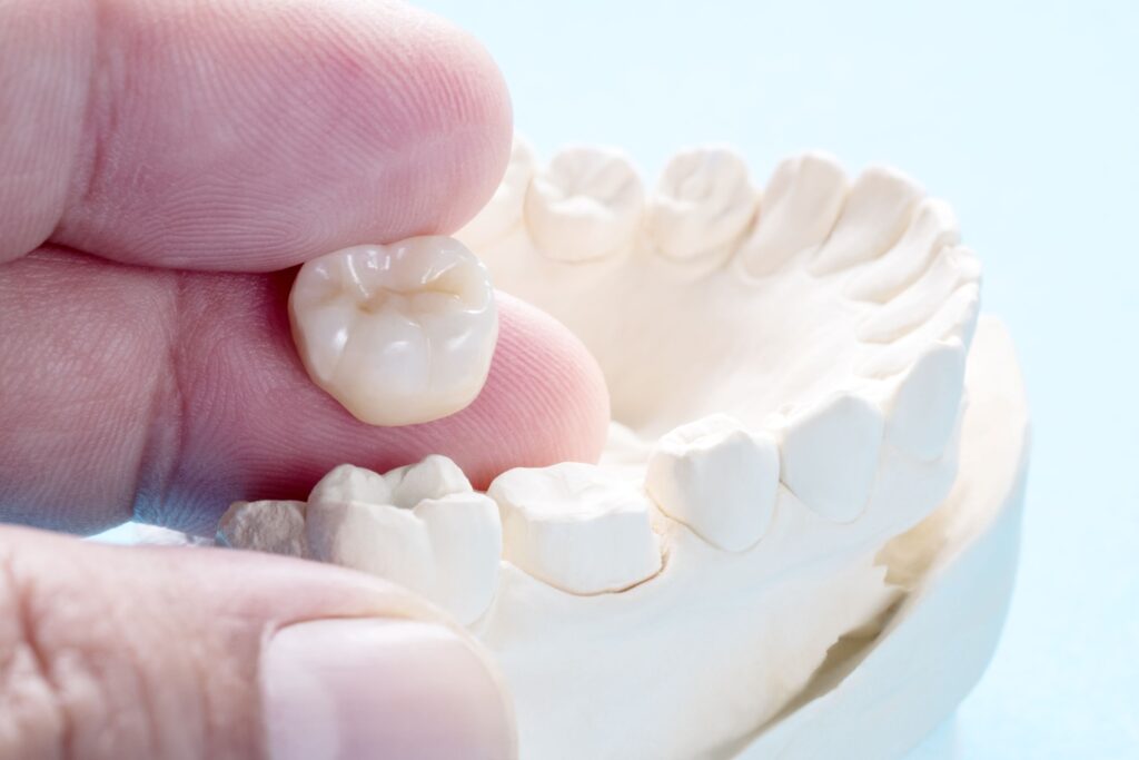 Fingers holding a dental crown over a model jaw