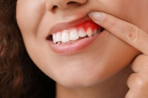 Woman raising lip to reveal red gums.