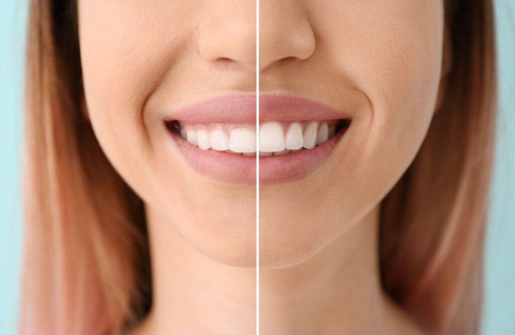 A woman’s smile before and after gum recontouring