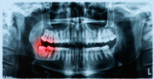 x-ray image of impacted wisdom tooth